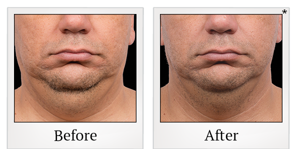 Before and After Photo 5 of Coolsculpting® treatment at SF Bay Cosmetic Surgery Medical Group in San Ramon