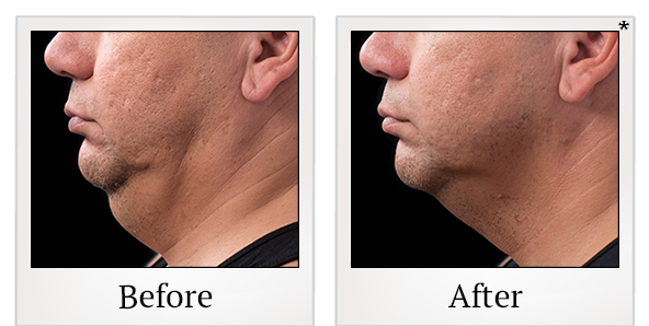 Before and After Photo 6 of Coolsculpting® treatment at SF Bay Cosmetic Surgery Medical Group in San Ramon