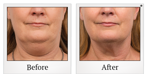 Before and After Photo 7 of Coolsculpting® treatment at SF Bay Cosmetic Surgery Medical Group in San Ramon