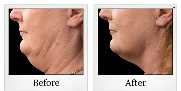 Before and After Photo 8 of Coolsculpting® treatment at SF Bay Cosmetic Surgery Medical Group in San Ramon