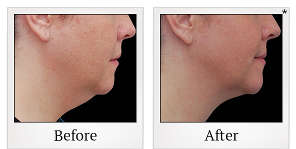 Before and After Photo 9 of Coolsculpting® treatment at SF Bay Cosmetic Surgery Medical Group in San Ramon
