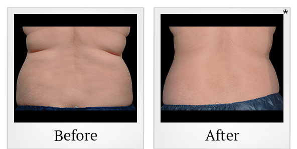 Before and After Photo 1 of Coolsculpting® treatment at SF Bay Cosmetic Surgery Medical Group in San Ramon