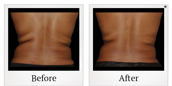 Before and After Photo 10 of Coolsculpting® treatment at SF Bay Cosmetic Surgery Medical Group in San Ramon