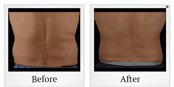 Before and After Photo 11 of Coolsculpting® treatment at SF Bay Cosmetic Surgery Medical Group in San Ramon