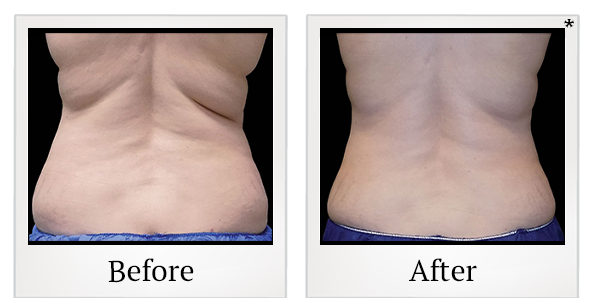 Before and After Photo 12 of Coolsculpting® treatment at SF Bay Cosmetic Surgery Medical Group in San Ramon