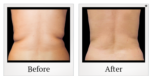 Before and After Photo 13 of Coolsculpting® treatment at SF Bay Cosmetic Surgery Medical Group in San Ramon