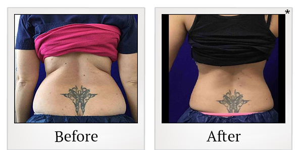 Before and After Photo 14 of Coolsculpting® treatment at SF Bay Cosmetic Surgery Medical Group in San Ramon