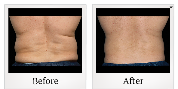 Before and After Photo 2 of Coolsculpting® treatment at SF Bay Cosmetic Surgery Medical Group in San Ramon