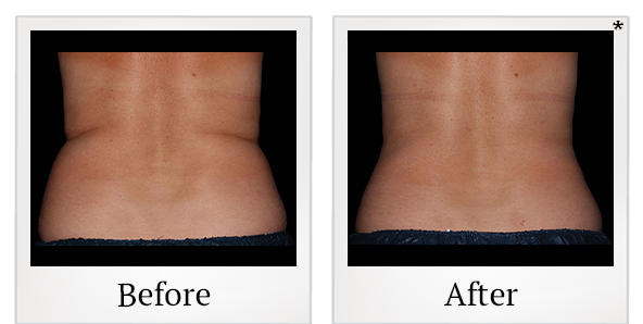 Before and After Photo 3 of Coolsculpting® treatment at SF Bay Cosmetic Surgery Medical Group in San Ramon