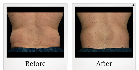 Before and After Photo 4 of Coolsculpting® treatment at SF Bay Cosmetic Surgery Medical Group in San Ramon