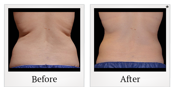 Before and After Photo 5 of Coolsculpting® treatment at SF Bay Cosmetic Surgery Medical Group in San Ramon