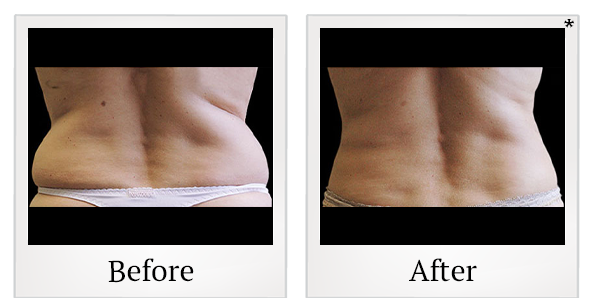 Before and After Photo 6 of Coolsculpting® treatment at SF Bay Cosmetic Surgery Medical Group in San Ramon