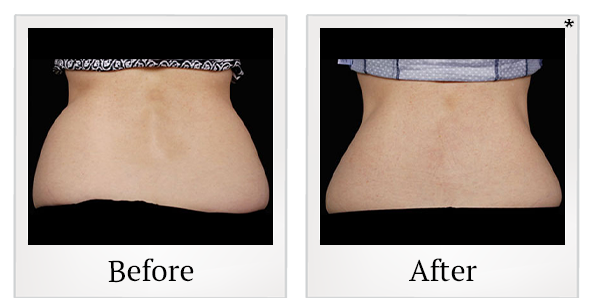 Before and After Photo 7 of Coolsculpting® treatment at SF Bay Cosmetic Surgery Medical Group in San Ramon