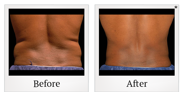 Before and After Photo 8 of Coolsculpting® treatment at SF Bay Cosmetic Surgery Medical Group in San Ramon