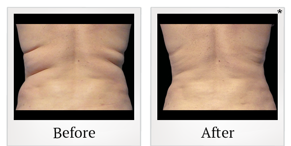 Before and After Photo 9 of Coolsculpting® treatment at SF Bay Cosmetic Surgery Medical Group in San Ramon