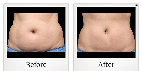 Before and After Photo 1 of Coolsculpting® treatment at SF Bay Cosmetic Surgery Medical Group in San Ramon