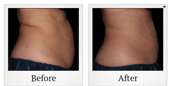 Before and After Photo 10 of Coolsculpting® treatment at SF Bay Cosmetic Surgery Medical Group in San Ramon