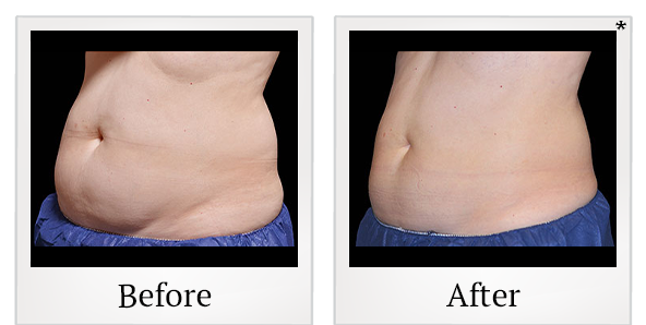 Before and After Photo 11 of Coolsculpting® treatment at SF Bay Cosmetic Surgery Medical Group in San Ramon