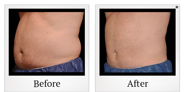 Before and After Photo 12 of Coolsculpting® treatment at SF Bay Cosmetic Surgery Medical Group in San Ramon