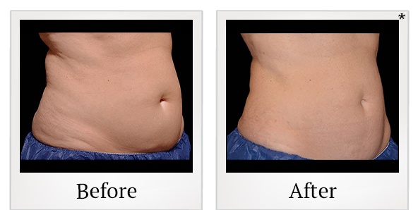 Before and After Photo 13 of Coolsculpting® treatment at SF Bay Cosmetic Surgery Medical Group in San Ramon