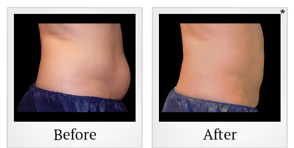 Before and After Photo 14 of Coolsculpting® treatment at SF Bay Cosmetic Surgery Medical Group in San Ramon