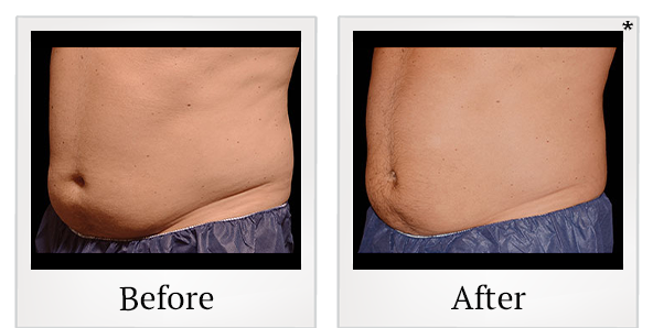 Before and After Photo 15 of Coolsculpting® treatment at SF Bay Cosmetic Surgery Medical Group in San Ramon
