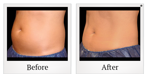 Before and After Photo 16 of Coolsculpting® treatment at SF Bay Cosmetic Surgery Medical Group in San Ramon