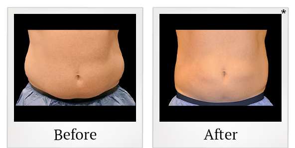 Before and After Photo 17 of Coolsculpting® treatment at SF Bay Cosmetic Surgery Medical Group in San Ramon