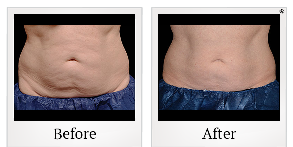 Before and After Photo 18 of Coolsculpting® treatment at SF Bay Cosmetic Surgery Medical Group in San Ramon
