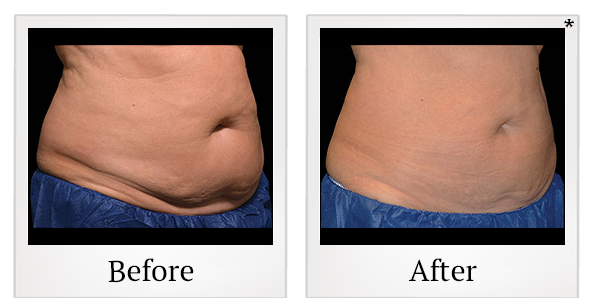 Before and After Photo 19 of Coolsculpting® treatment at SF Bay Cosmetic Surgery Medical Group in San Ramon