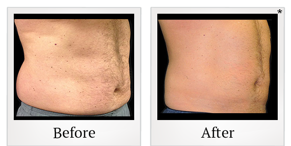 Before and After Photo 2 of Coolsculpting® treatment at SF Bay Cosmetic Surgery Medical Group in San Ramon