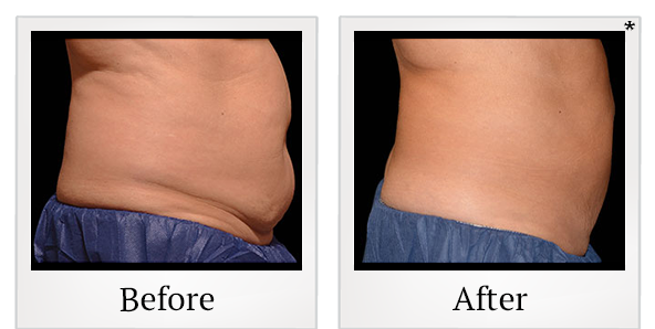 Before and After Photo 20 of Coolsculpting® treatment at SF Bay Cosmetic Surgery Medical Group in San Ramon