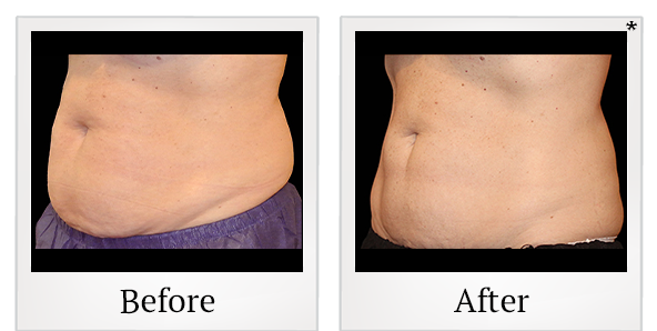 Before and After Photo 22 of Coolsculpting® treatment at SF Bay Cosmetic Surgery Medical Group in San Ramon