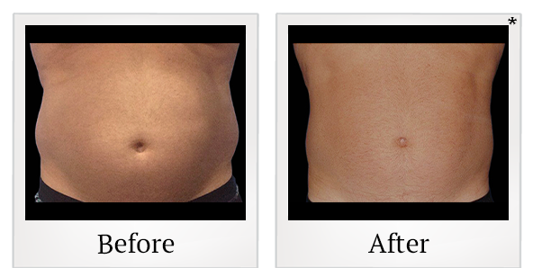 Before and After Photo 21 of Coolsculpting® treatment at SF Bay Cosmetic Surgery Medical Group in San Ramon