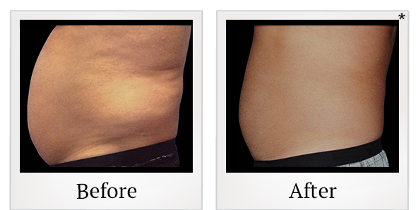 Before and After Photo 24 of Coolsculpting® treatment at SF Bay Cosmetic Surgery Medical Group in San Ramon