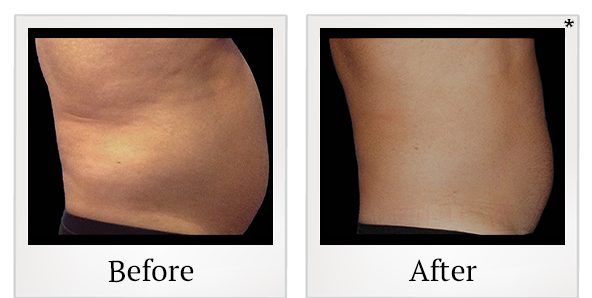 Before and After Photo 25 of Coolsculpting® treatment at SF Bay Cosmetic Surgery Medical Group in San Ramon