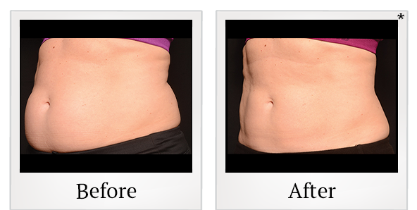 Before and After Photo 26 of Coolsculpting® treatment at SF Bay Cosmetic Surgery Medical Group in San Ramon