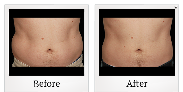 Before and After Photo 27 of Coolsculpting® treatment at SF Bay Cosmetic Surgery Medical Group in San Ramon
