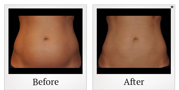 Before and After Photo 28 of Coolsculpting® treatment at SF Bay Cosmetic Surgery Medical Group in San Ramon