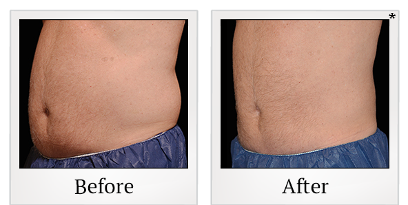 Before and After Photo 29 of Coolsculpting® treatment at SF Bay Cosmetic Surgery Medical Group in San Ramon