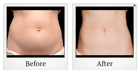 Before and After Photo 3 of Coolsculpting® treatment at SF Bay Cosmetic Surgery Medical Group in San Ramon