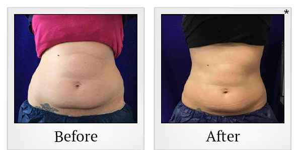 Before and After Photo 30 of Coolsculpting® treatment at SF Bay Cosmetic Surgery Medical Group in San Ramon