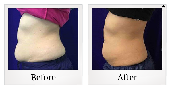 Before and After Photo 31 of Coolsculpting® treatment at SF Bay Cosmetic Surgery Medical Group in San Ramon