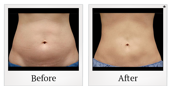 Before and After Photo 4 of Coolsculpting® treatment at SF Bay Cosmetic Surgery Medical Group in San Ramon