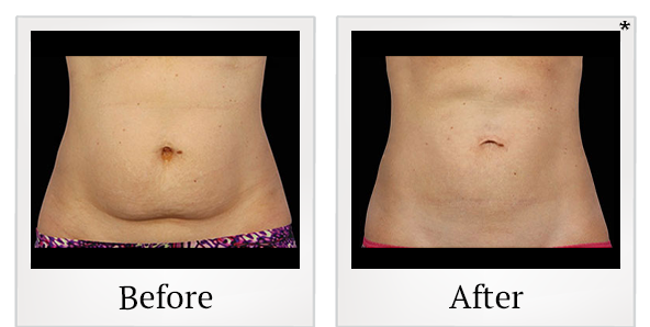 Before and After Photo 5 of Coolsculpting® treatment at SF Bay Cosmetic Surgery Medical Group in San Ramon