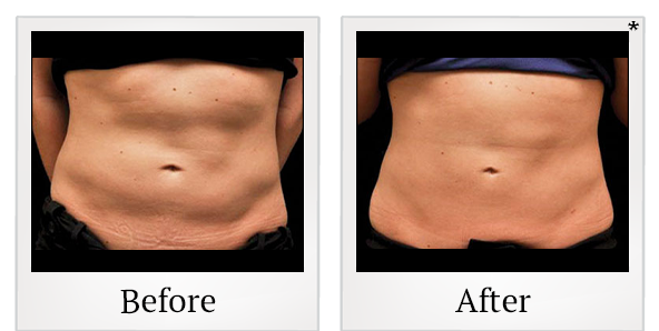 Before and After Photo 6 of Coolsculpting® treatment at SF Bay Cosmetic Surgery Medical Group in San Ramon