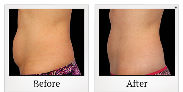 Before and After Photo 7 of Coolsculpting® treatment at SF Bay Cosmetic Surgery Medical Group in San Ramon