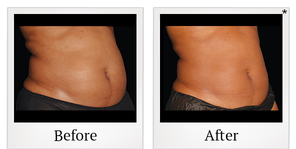 Before and After Photo 8 of Coolsculpting® treatment at SF Bay Cosmetic Surgery Medical Group in San Ramon