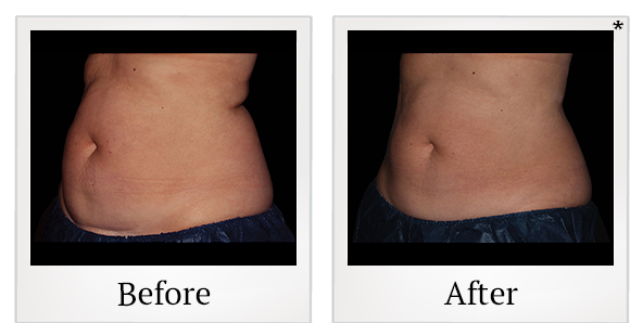Before and After Photo 9 of Coolsculpting® treatment at SF Bay Cosmetic Surgery Medical Group in San Ramon