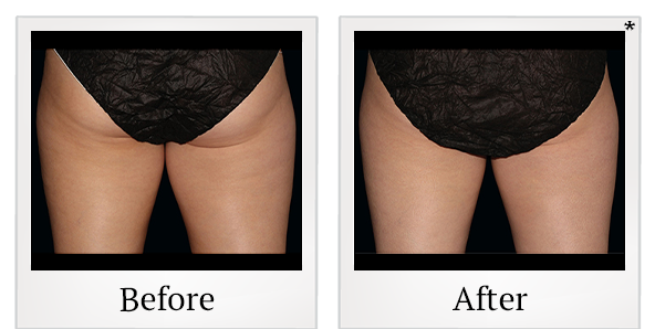 Before and After Photo 1 of Coolsculpting® treatment at SF Bay Cosmetic Surgery Medical Group in San Ramon